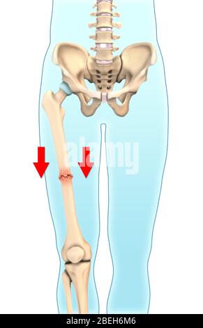 Fracture osseuse impactée, illustration Banque D'Images