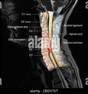 Lésion du rachis cervical, IRM Banque D'Images
