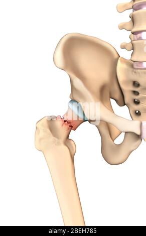 Fracture de la hanche, illustration Banque D'Images