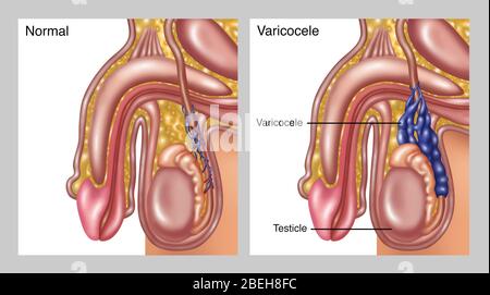 Varicocèle scrotale, illustration Banque D'Images