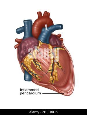 Cœur avec péricardite, illustration Banque D'Images