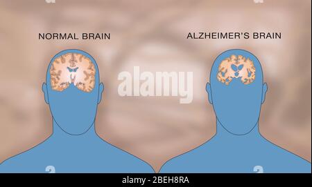 Comparaison des cerveaux normaux et Alzheimer Banque D'Images