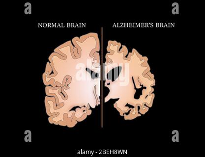 Comparaison des cerveaux normaux et Alzheimer Banque D'Images