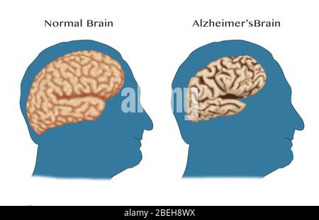 Comparaison des cerveaux normaux et Alzheimer Banque D'Images