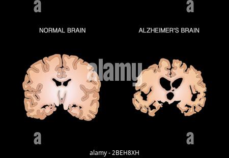 Comparaison des cerveaux normaux et Alzheimer Banque D'Images