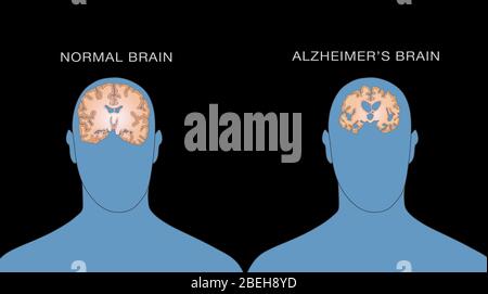 Comparaison des cerveaux normaux et Alzheimer Banque D'Images