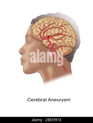 Anévrisme cérébral in situ Banque D'Images