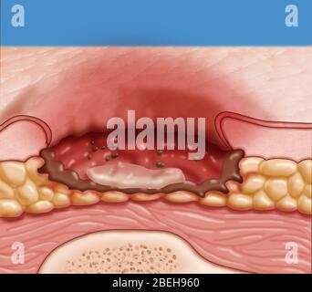 Plaie de pression, niveau 3 Banque D'Images