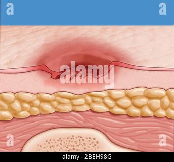 Plaie de pression, niveau 2 Banque D'Images