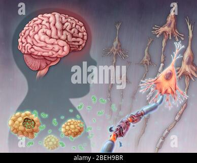 Maladie de Tay-sachs, illustration Banque D'Images