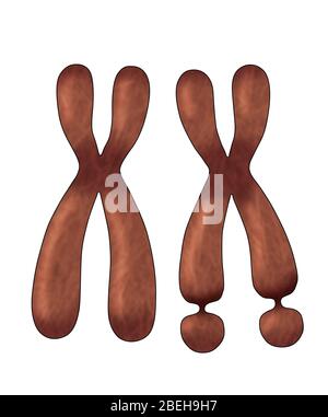 Chromosome X fragile, Illustration Banque D'Images