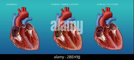 Coeur, Fib et Flutter auriculaire, Illustration Banque D'Images