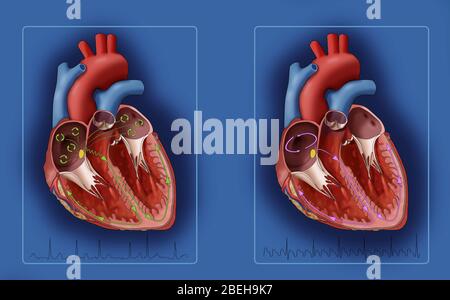 Fibrillation et flutter atriaux, illustration Banque D'Images