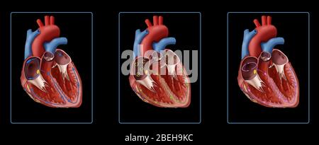 Illustration comparant un muscle cardiaque avec un battement de coeur normal et des battements irréguliers. Montrant un cœur normal (gauche), un cœur avec fibrillation auriculaire (centre) et un cœur avec flutter auriculaire (droite). Comme le montre l'illustration de fibrillation auriculaire (AFib), les signaux électriques désorganisés (cercles verts) proviennent du nœud sa (point jaune). Avec le flutter auriculaire, les signaux électriques se déplacent autour et autour de l'oreillette (cercle rose) ; ces signaux de ciautour rendent l'oreillette trop rapide. Banque D'Images