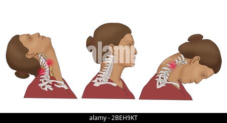 Coup de fouet. Le coup de fouet survient le plus souvent lors d'un accident d'automobile réel, mais les blessures peuvent également résulter d'un accident sportif, d'un abus physique ou d'autres trama. Illustration. Banque D'Images