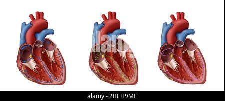 Coeur, Fib et Flutter auriculaire, Illustration Banque D'Images