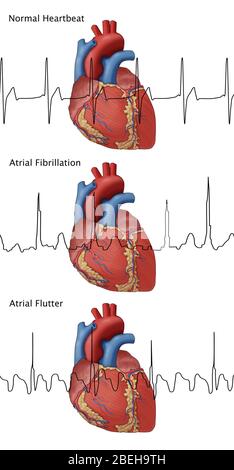 Pulsation, Fib et flutter auriculaire, illustration Banque D'Images