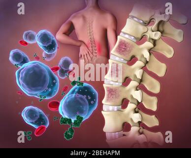 Myeloma multiple Banque D'Images