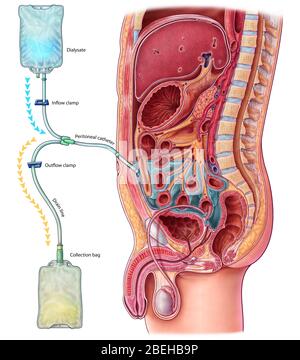 Dialyse péritonéale, illustration Banque D'Images