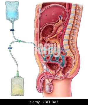 Dialyse péritonéale, illustration Banque D'Images
