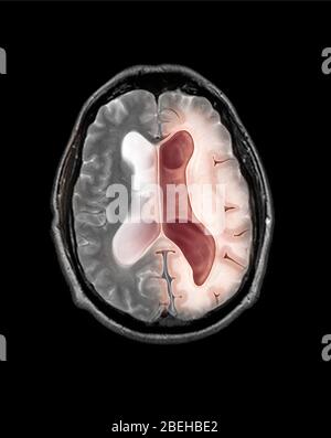 Communiquer l'hydrocéphalie IRM (NPH). Banque D'Images