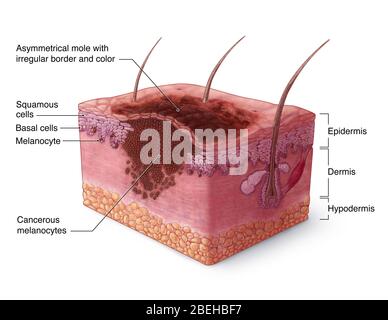 Illustration du mélanome Banque D'Images