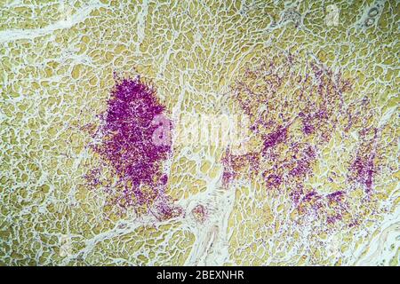 Candida dans le muscle cardiaque d'un malade du SIDA, 100x Banque D'Images