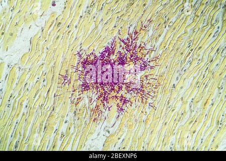 Candida dans le muscle cardiaque d'un malade du SIDA, 100x Banque D'Images