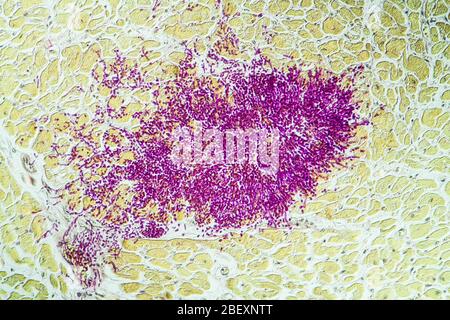 Candida dans le muscle cardiaque d'un malade du SIDA, 100x Banque D'Images