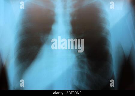 Gros plan sur les rayons X des poumons humains sains. L'inflammation pulmonaire, la tuberculose, le coronavirus n'ont pas été détectés. Image radiographique de la poitrine de la femme Banque D'Images