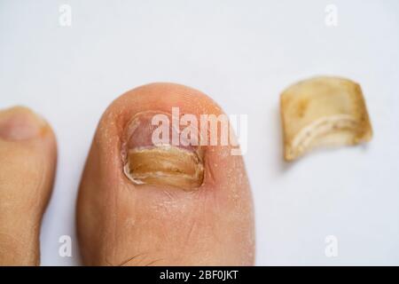 Ongles de pied mâle cassés et infection fongique Banque D'Images