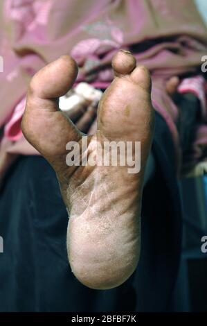 Close up d'un pied gauche avec les deuxième, troisième et quatrième orteils amputés. Banque D'Images