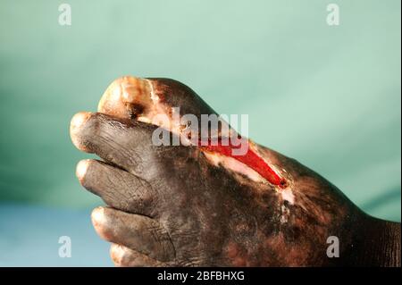 Actinomycetome du pied gauche. Mycétome est une maladie rare trouvée dans les tropiques. Il s'agit d'une infection chronique localisée de la peau et de la sous-lyine Banque D'Images