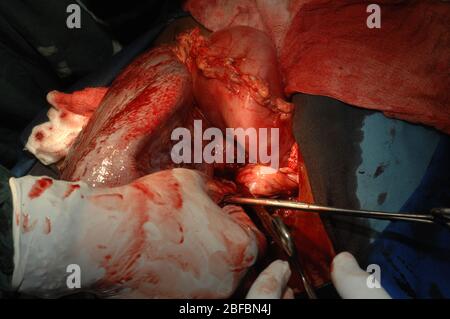 Chirurgien enlevant une rate agrandie pendant la chirurgie. Banque D'Images