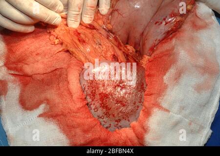 Chirurgien enlevant une rate agrandie pendant la chirurgie. Banque D'Images