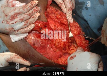 Suppression de l'axilla des ganglions lymphatiques contenant des secondaires. (Mastectomie + clairance axillaire) Banque D'Images