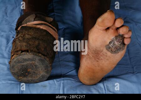 Mycétome sur la semelle du pied droit d'un patient. Mycétome est une maladie rare trouvée dans les tropiques. Il s'agit d'une infection chronique localisée de TH Banque D'Images