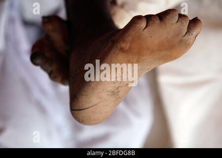 Les pieds d'un jeune homme souffrant de lèpre. La lèpre est une maladie inflammatoire chronique causée par la mycobactérie leprae. La lèpre endommage les nerfs, Banque D'Images