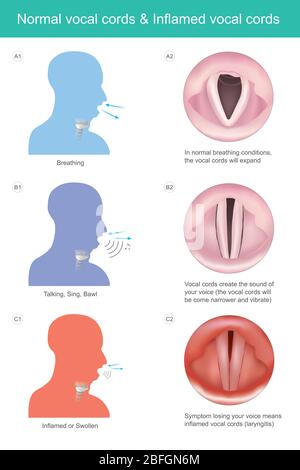 Cordes vocales normales et cordes vocales enflammées. Les cordes vocales créent le son de votre voix pour parler ou chanter, si perdre votre voix signifie cordes vocales Illustration de Vecteur