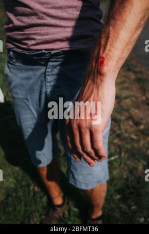 abrasion sur la main masculine après un accident de skateboard Banque D'Images