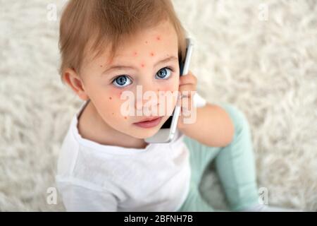 Petite fille avec boutons rouges à la maison. Concept de varicelle Banque D'Images