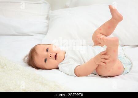 Petit enfant avec une éruption rouge posée sur le lit. Concept d'allergies de bébés Banque D'Images