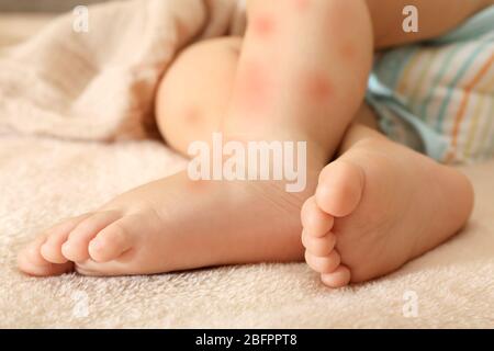 Jambes de petit enfant avec éruption rouge, fermeture. Concept d'allergies de bébés Banque D'Images