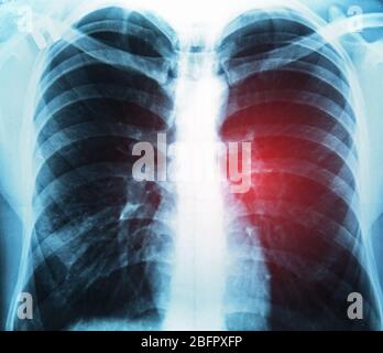 Image radiographique de la poitrine. Concept de cancer du poumon Banque D'Images