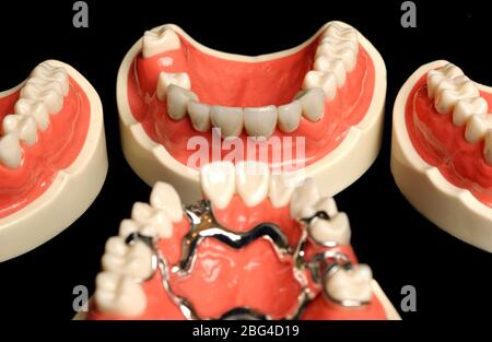 Un ensemble de prothèses, l'une des prothèses contient une étrésillon métallique qui est utilisé pour aligner les dents. Les prothèses dentaires ou les fausses dents sont faites à partir d'une base acrylique sur Banque D'Images