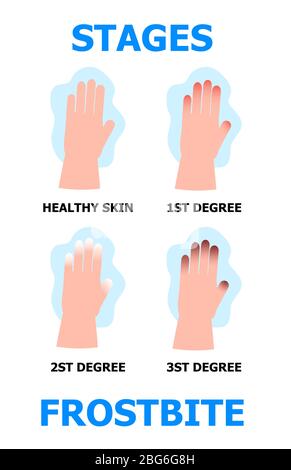 Vecteur info-graphique des étapes de gelure. Hypothermie en hiver. Des problèmes de peau de doigts de gel sont affichés. Illustration de Vecteur