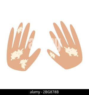 Vitiligo sur les mains. Taches blanches sur la peau des mains. Illustration vectorielle infographique. Illustration de Vecteur