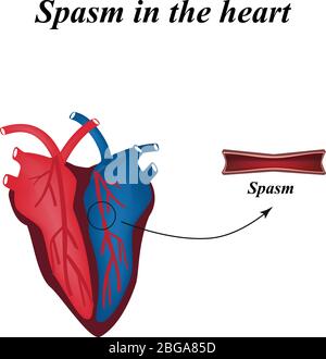 Spasme des artères du cœur. Infographies. Illustration vectorielle Illustration de Vecteur