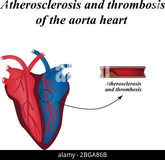 Athérosclérose et thrombose des artères du coeur. Infographies. Illustration vectorielle Illustration de Vecteur