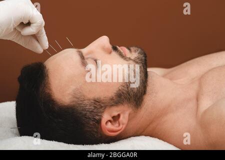 Traitement d'acupuncture pour maux de tête et migraines. Gros plan aiguilles d'acupuncture dans le front d'un homme sur un fond brun Banque D'Images